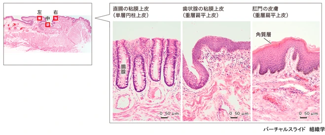 Hình ② cho thấy thay đổi hình thái biểu mô của trực tràng và hậu môn.