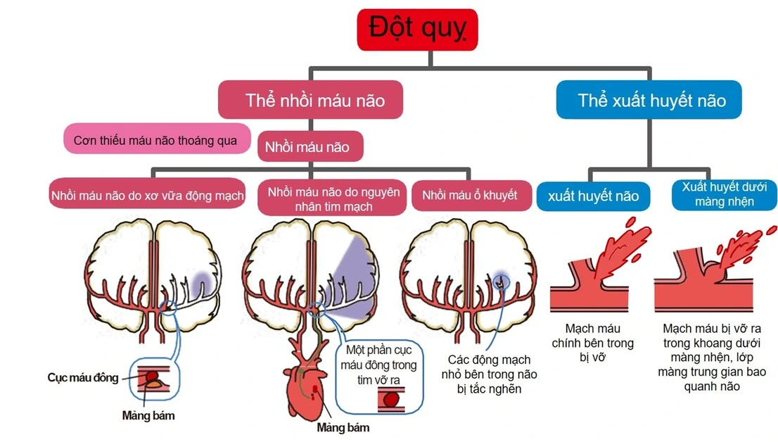 Phân loại đột quỵ