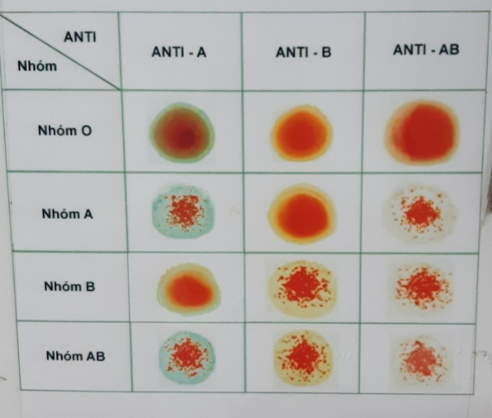 Có các loại máu khác nhau là do các phân tử khác nhau trên bề mặt của tế bào hồng cầu