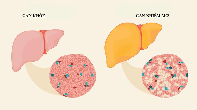 benh-gan-nhiem-mo-khong-do-ruou-1