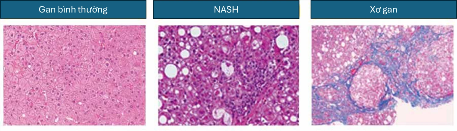 benh-gan-nhiem-mo-khong-do-ruou-2