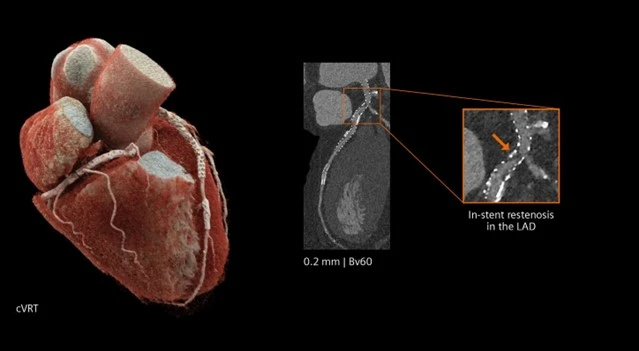 ct-photon-counting-1