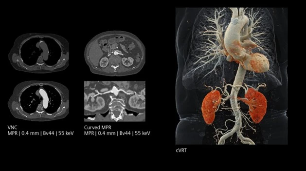 ct-photon-counting-2