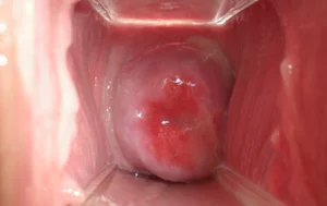 Hình 2. Bệnh lậu ở nữ giới (viêm cổ tử cung mủ nhầy)