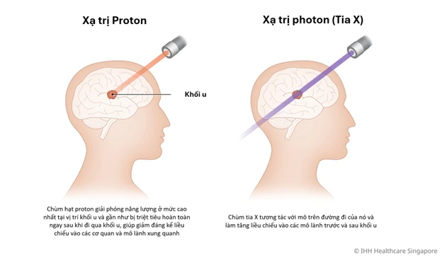 Khác biệt giữa Xạ trị Proton và Xạ trị photon (Tia X)