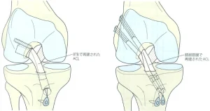 Hình ảnh phẫu thuật tái tạo dây chằng chéo trước (ACL)